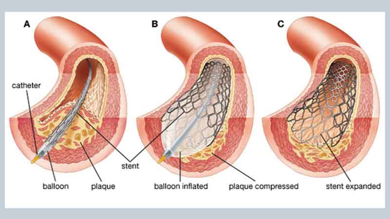 Complex Coronary Angioplasties.